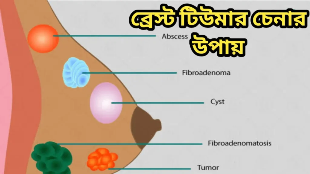 ব্রেস্ট টিউমার চেনার উপায় || ব্রেস্ট টিউমার সিম্পটমস ইন বাঙ্গালী 1 20250723 101821