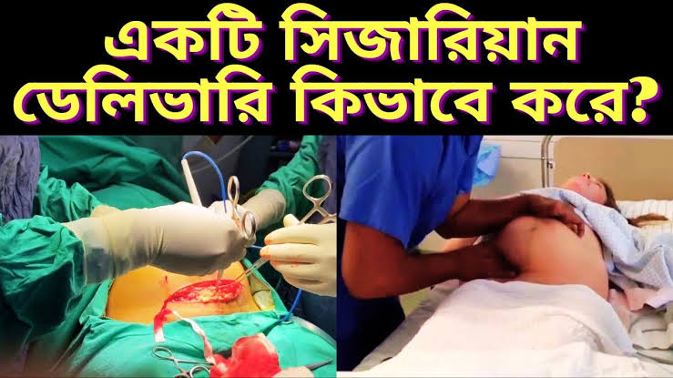 সিজার কিভাবে করে